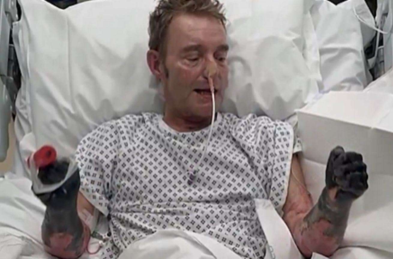 South Thanet MP Craig Mackinlay had to have his arms and legs amputated after suffering from a devastating case of sepsis. Picture: GB NEWS