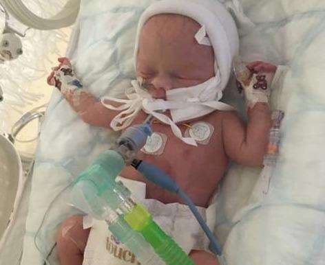 Baby Tommy Small was born seven weeks early with gastroschisis