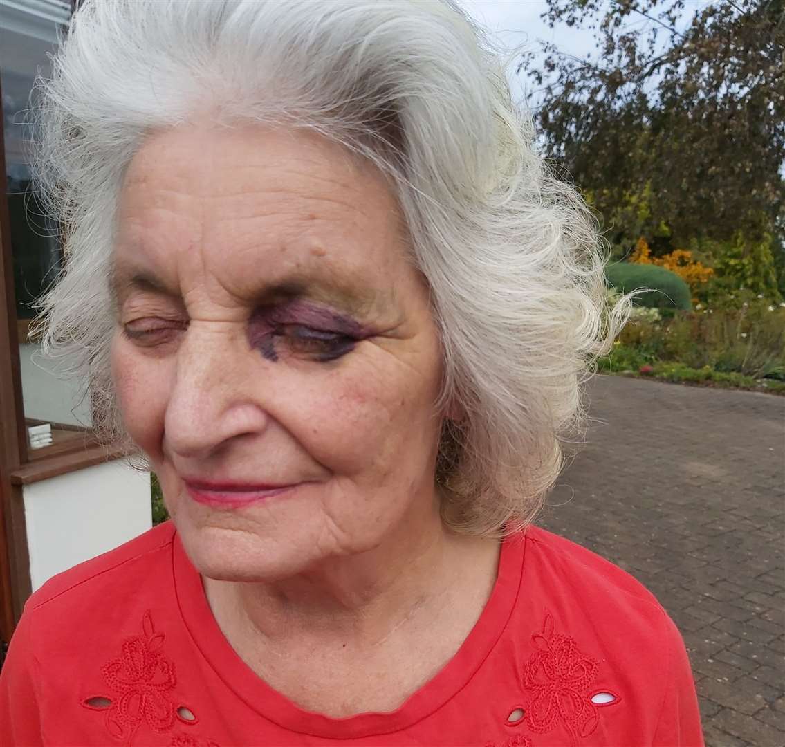 The bruise on Joan Stone's face, where was she struck with a gun