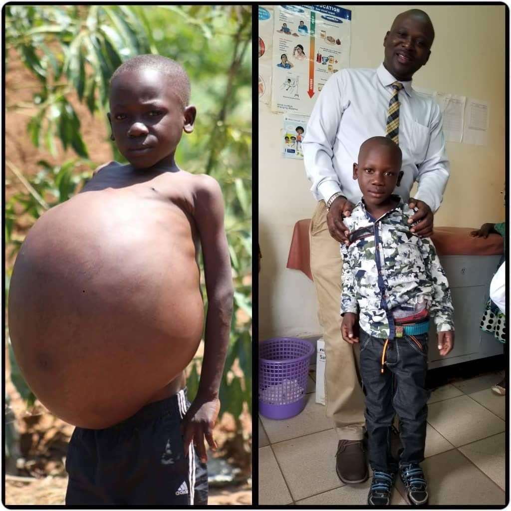 Allan before the surgery that saved his life and after the surgery with surgeon Dr Nasser Kakembo (KidsOR/PA)