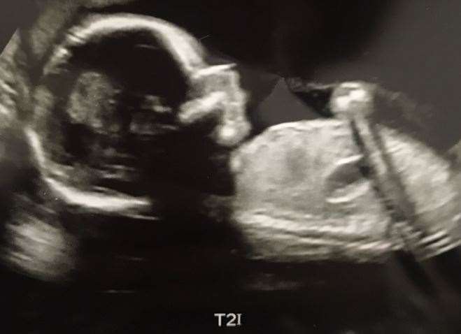 Scans shows triplet two