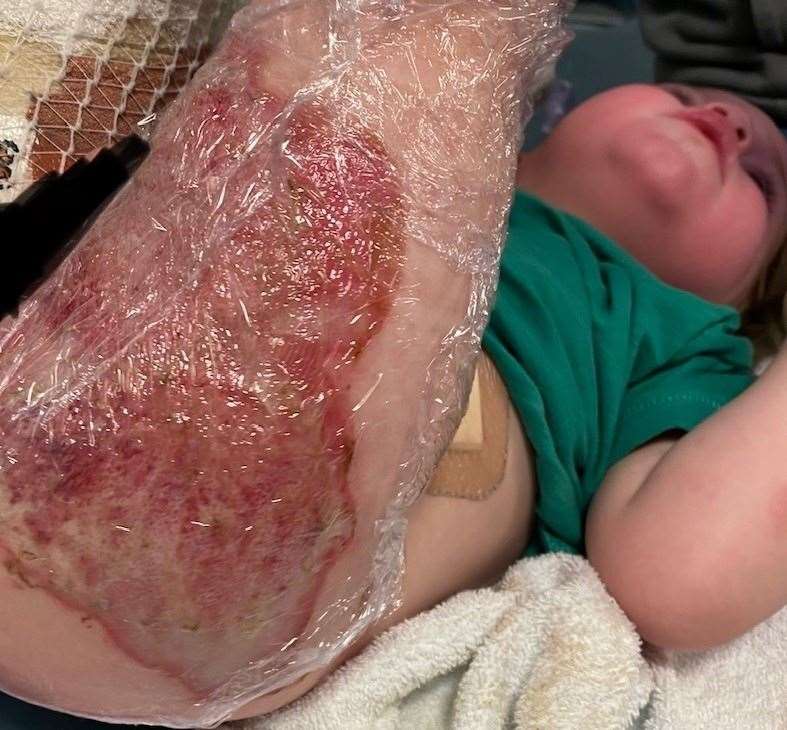 Mason's burns six days after surgery. Picture: Carrieanne Doyle