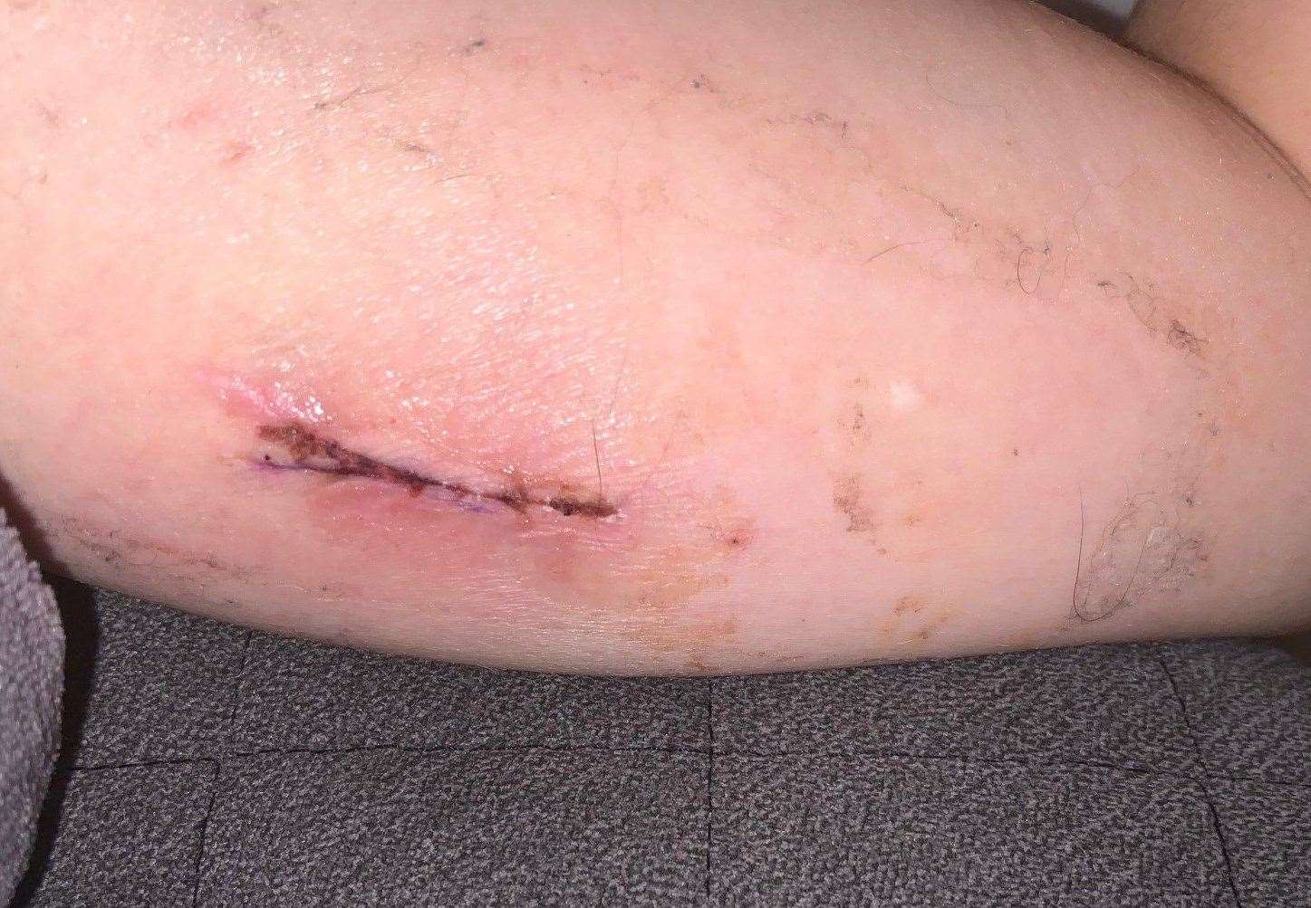 Despite a specialist surgeon's best efforts to remove the contraceptive implant in Danielle Jarrett's arm, they were unsuccessful. Picture: SWNS