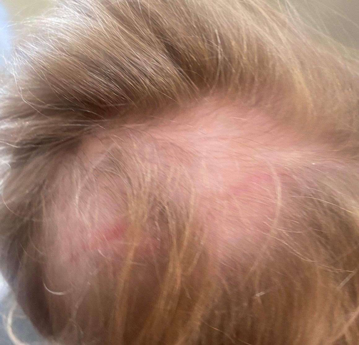 Rachel-Rose Cottrell has bald spots in her hair after the attack. Picture: Rachel Tanner
