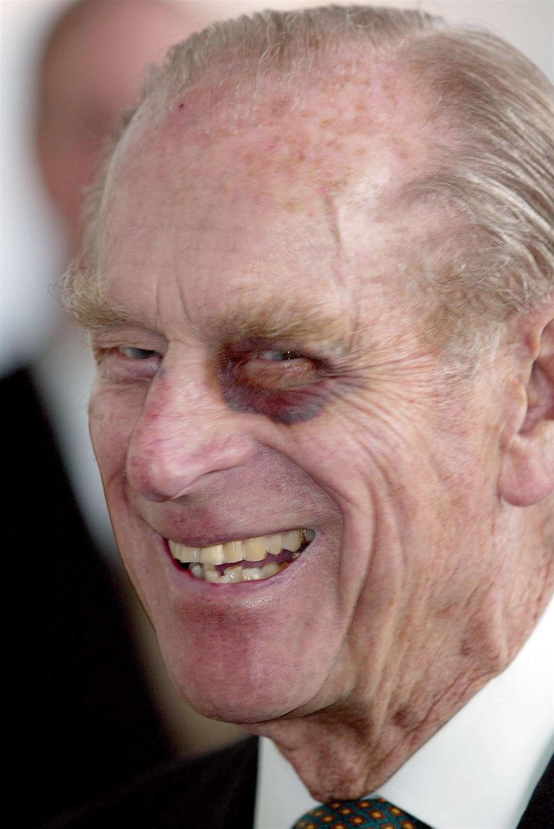 The Duke of Edinburgh sporting a black eye