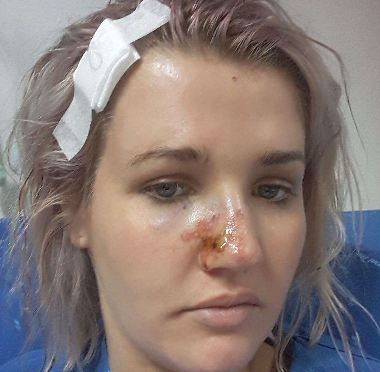 Abi Harrison was left battered and bruised after a motorbike crash in Thailand