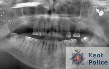 X-ray of Ray Weatherall's face from when he was shot by his wife’s secret lovers daughter, Heather Pollard, at Sandwich Marina. Picture: Kent Police