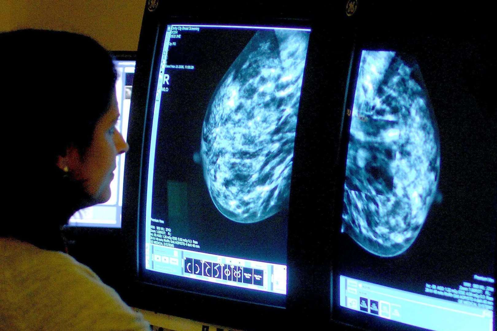 non-invasive-breast-cancer-risk-revealed