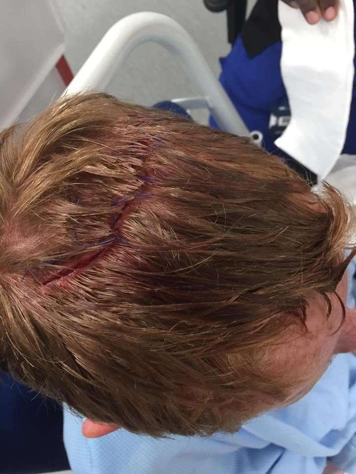Gash on Jordan's head following accident on castle slide at Beachfields, Sheerness (8258326)