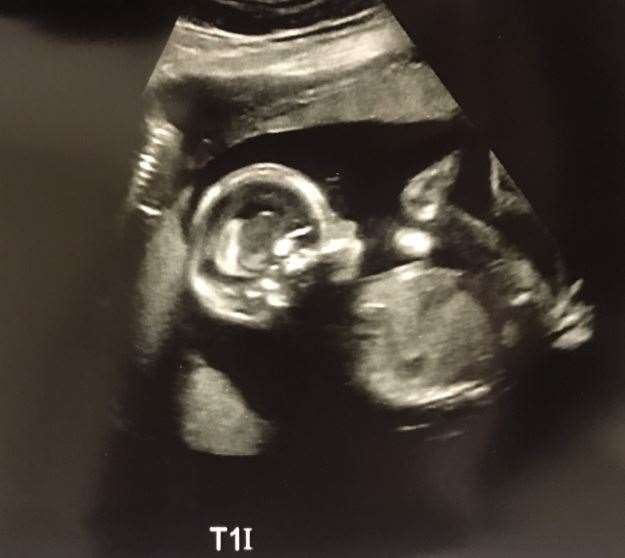This scan shows triplet one