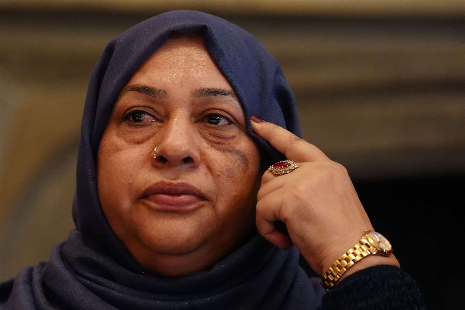 Shameem Akhtar shows off her injured face at the Midland Hotel in Manchester (Owen Humphreys/PA)