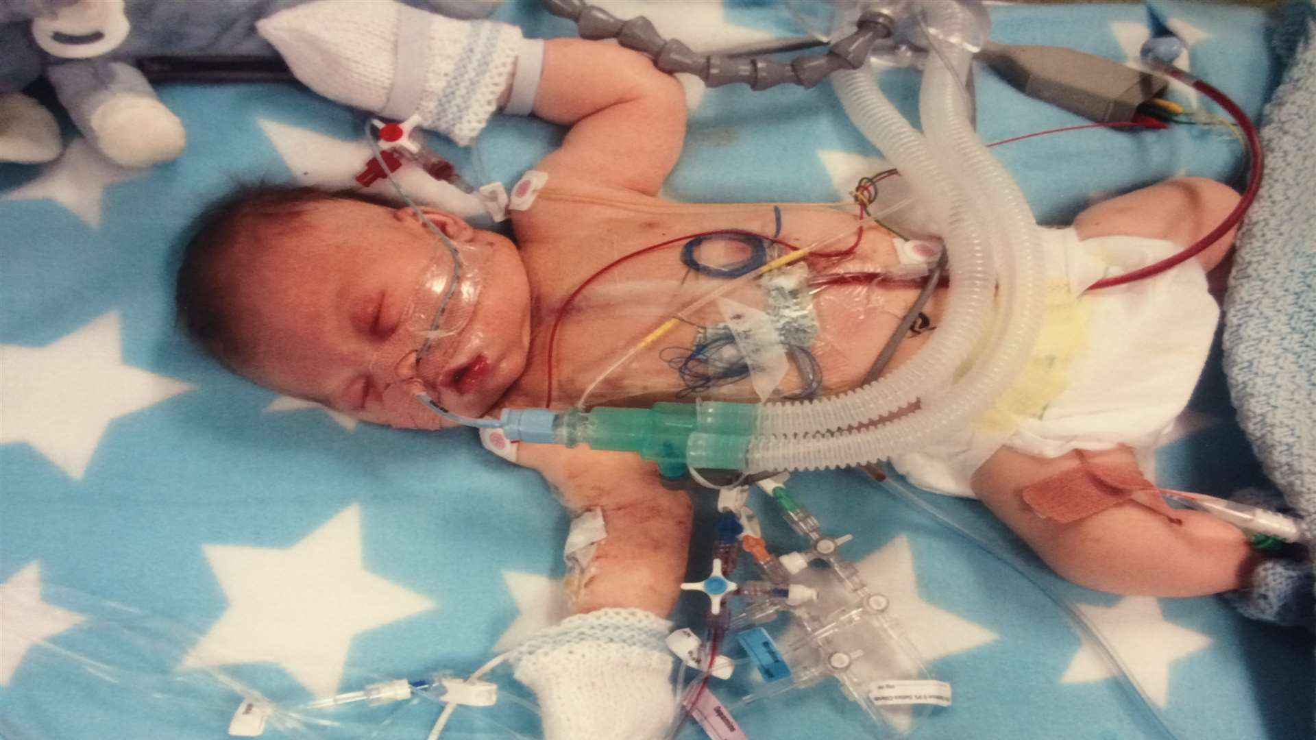Teddy-James Arnold having just gone through open heart surgery at Evelina London Children's Hospital
