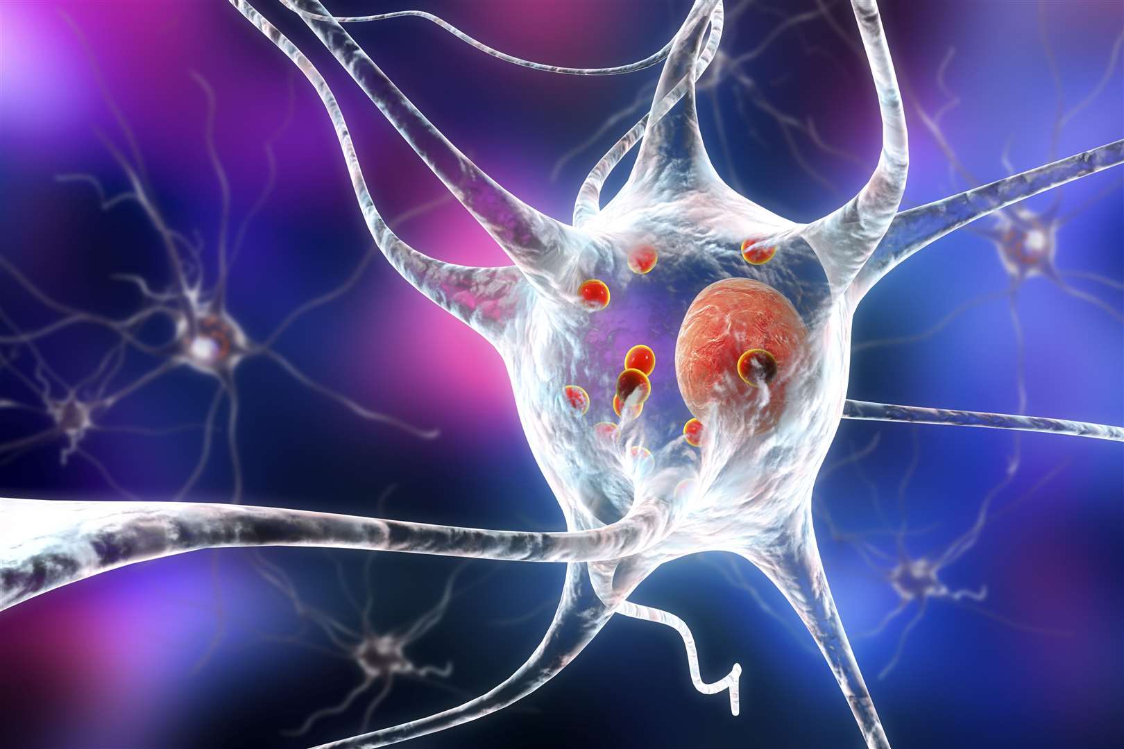 3D image showing neurons containing Lewy bodies, small red spheres which are deposits of proteins accumulated in brain cells which cause their progressive degeneration (University of Cambridge/PA)