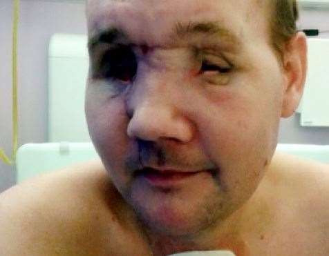 Andrew suffered severe facial injuries when an oil drum he was cutting with a plasma cutter exploded