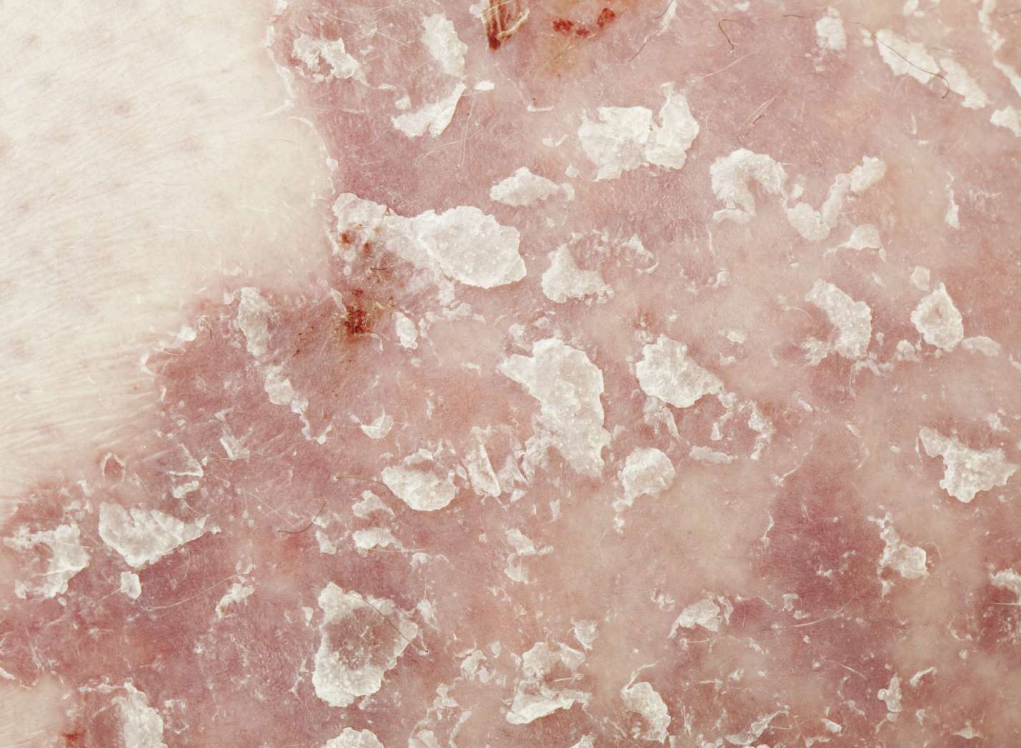 A close-up of the skin condition psoriasis.Stock image
