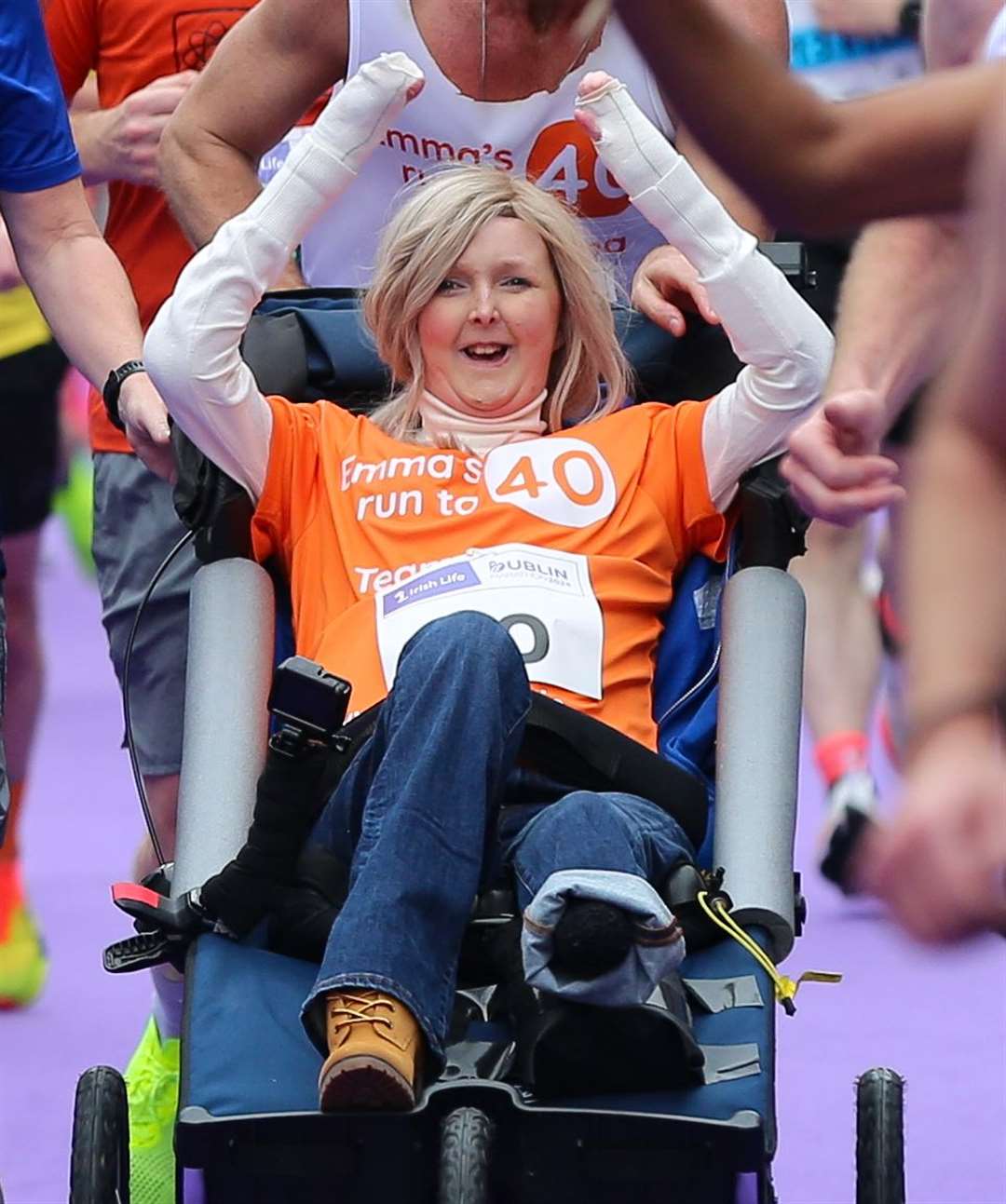 Emma Fogarty is Ireland’s longest survivor with the genetic condition epidermolysis bullosa (Damien Storan/PA)