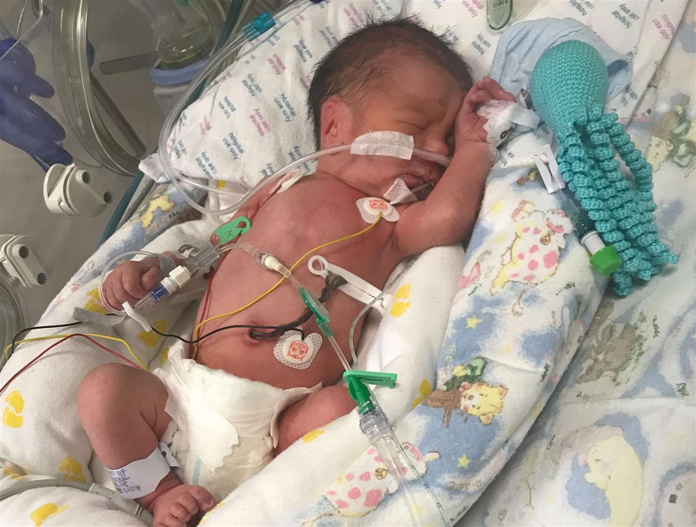 Vincent was born prematurely at 33 weeks