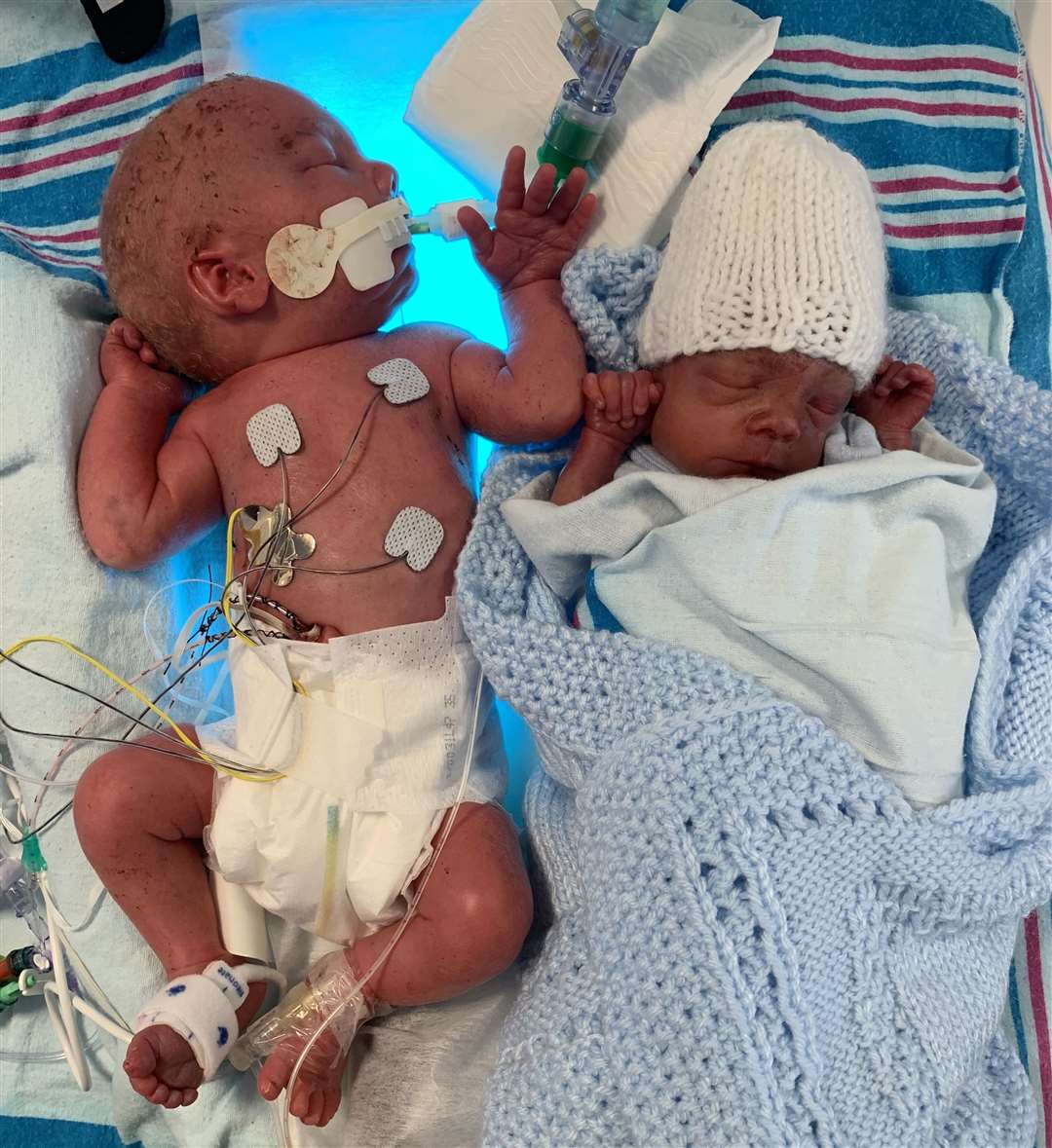 Dennie and Ronnie were born at 28 weeks