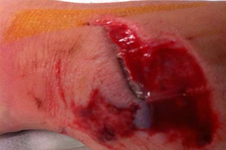 Hollie Apps was slashed across her hand with a meat cleaver at a Leysdown holiday park