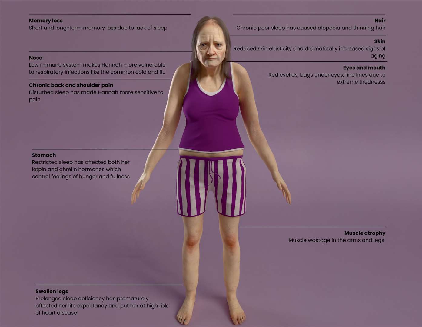 Hannah suffers from chronic back pain, thinning hair, sagging skin, swollen legs, baggy eyes and muscle atrophy (thinning of muscle mass) in the arms and legs