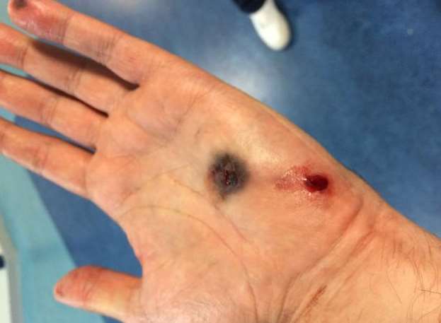The gunshot wound to PC Bird's hand
