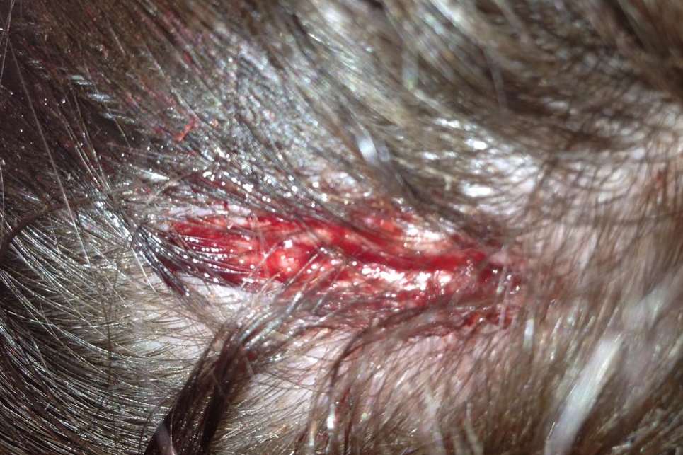 A nasty gash to disabled Natasha McMillan's head