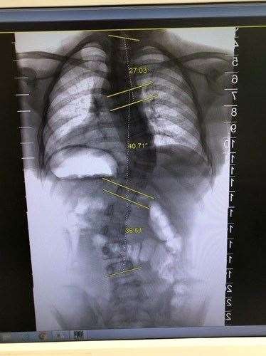 Izzy Harwood-Lucas is has triple scoliosis curve of the spine (23533239)