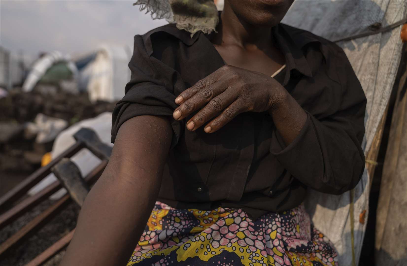 A woman in a Congo refugee camp suspects she may be infected with mpox (Moses Sawasawa/AP)