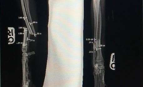 An x-ray of Steve's injury