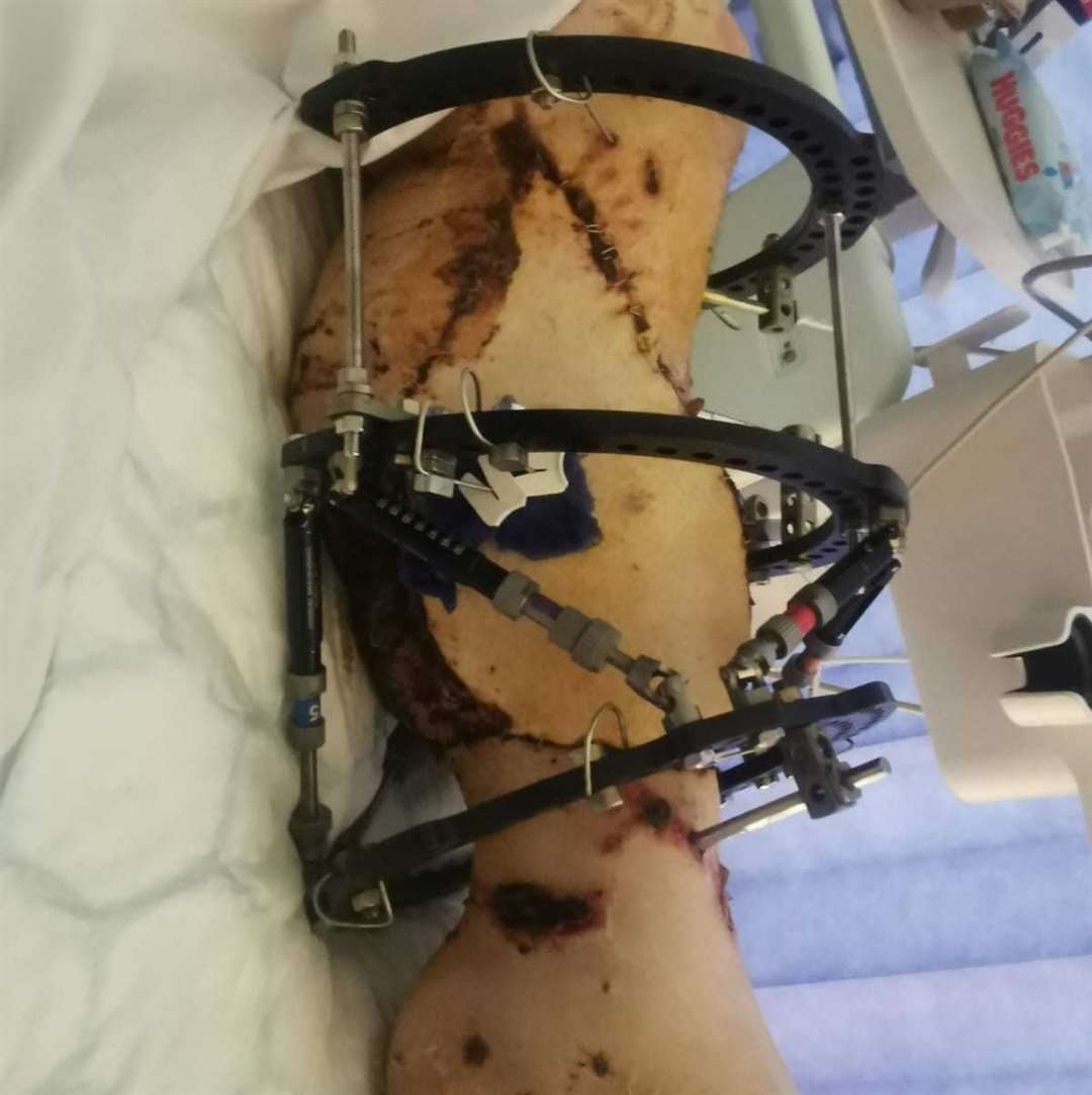 At one point it was feared Jordan's leg would be amputated. Picture: Shayla Raine