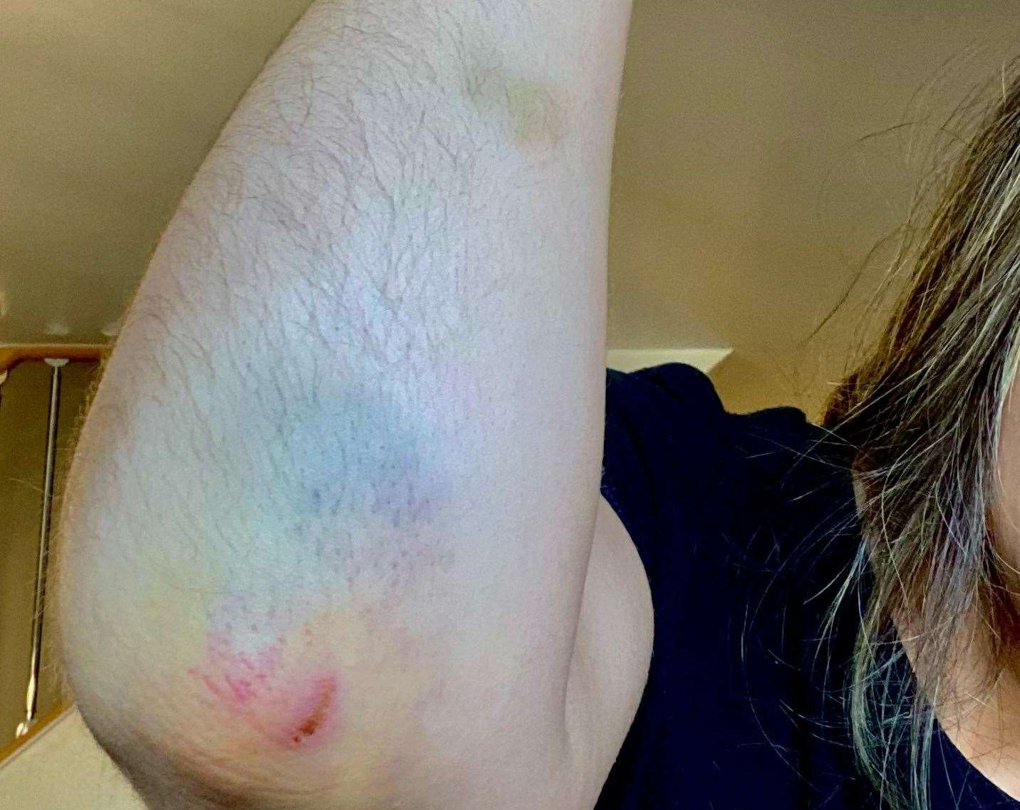 Kate Davies has been left with bruising to her arm. Picture: Kate Davies