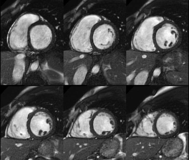 An image from a cardiac magnetic resonance scan (Raisi-Estabragh et al, 10.1093/ehjci/jeaa028/PA