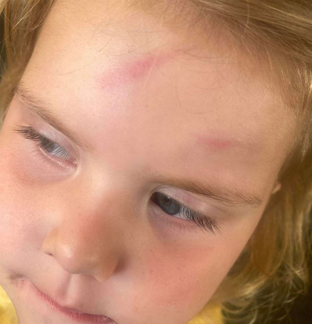 Rachel Tanner says the dog 'nipped' little Rachel-Rose’s face in Charing, near Ashford. Picture: Rachel Tanner