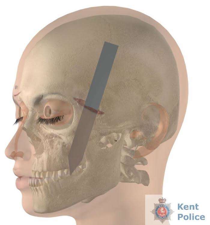 The injury to Ms Sadler-Ellis's head. Picture: Kent Police