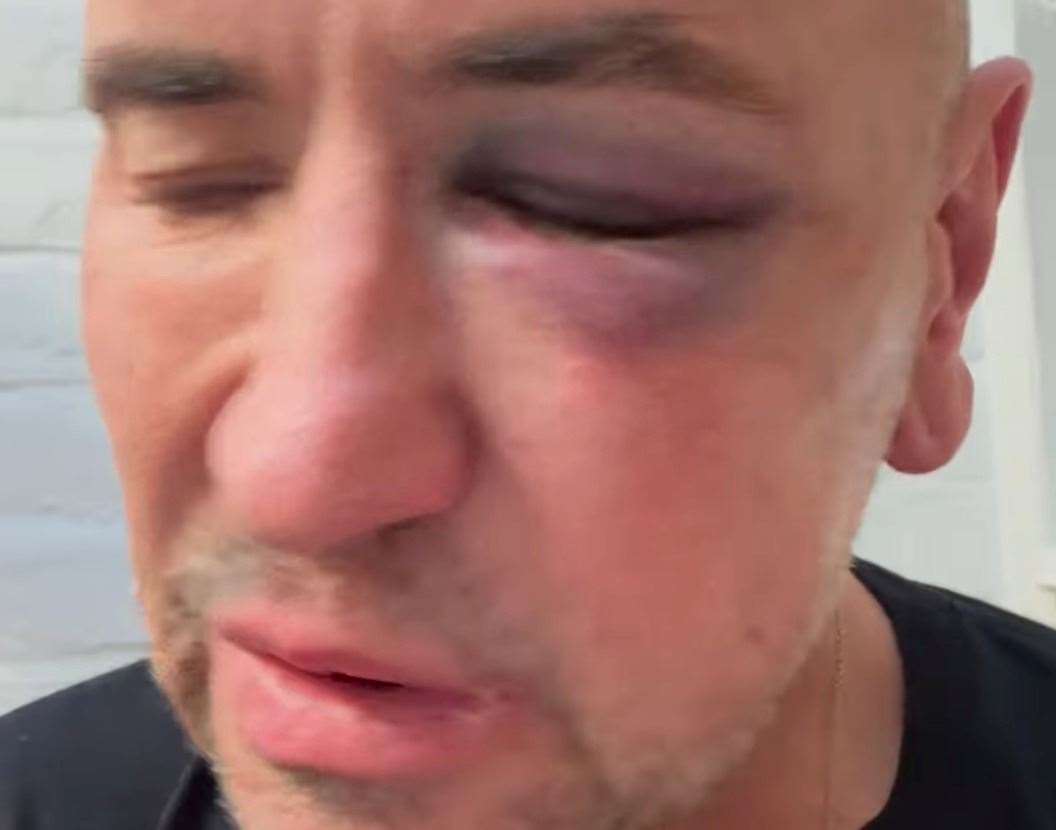 DJ Fat Tony has been left with a black eye after the Margate event. Picture: Fat Tony/Instagram