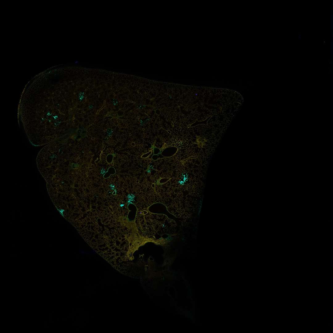 Skin cancer which has spread to the lung (Cancer Research UK/PA)