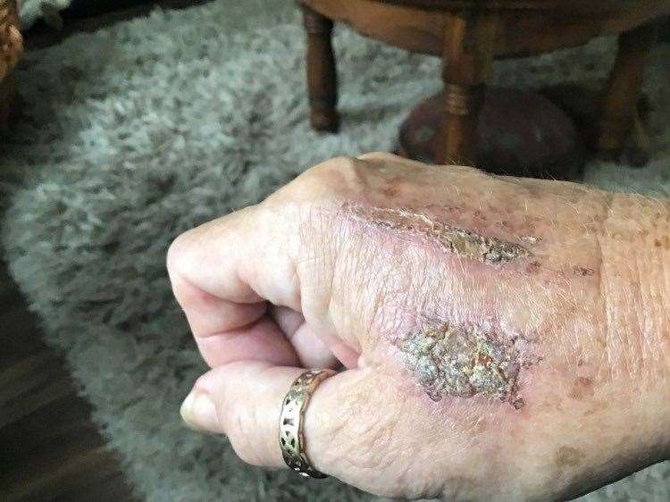 The wounds Patricia Poole, from Ash, suffered while trying to defend her dog Zebedee
