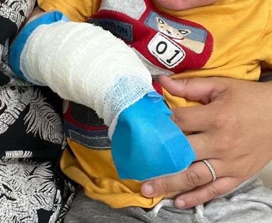 Eighteen-month-old Freddie Yeomans, from Ashford, has been bandaged up and referred to a burns unit after the incident