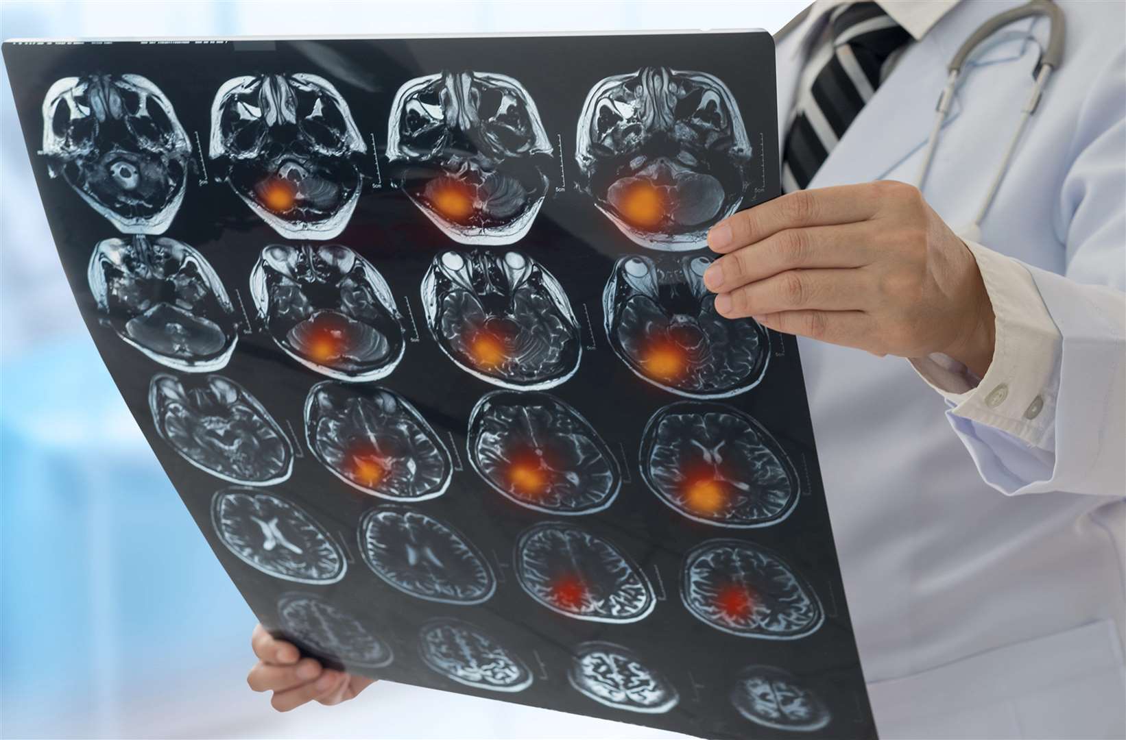 Under the proposals, the hyper acute stroke units would be located at Dartford’s Darent Valley Hospital, Maidstone Hospital, and William Harvey Hospital in Ashford