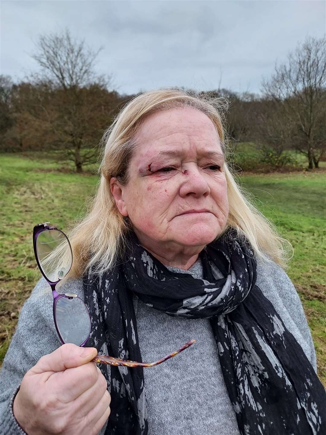 Angela Blacklocks suffered a cut and bruised eye