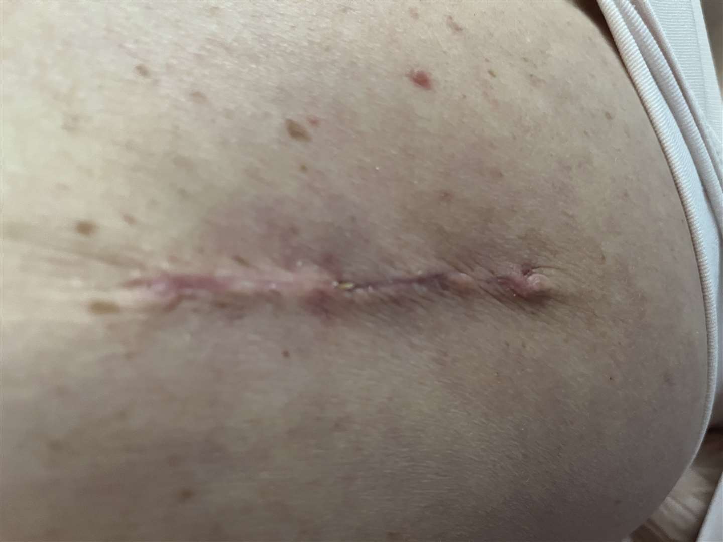 The 10cm scar on Natasha Gowan’s back after her operation (Cancer Research UK/PA)