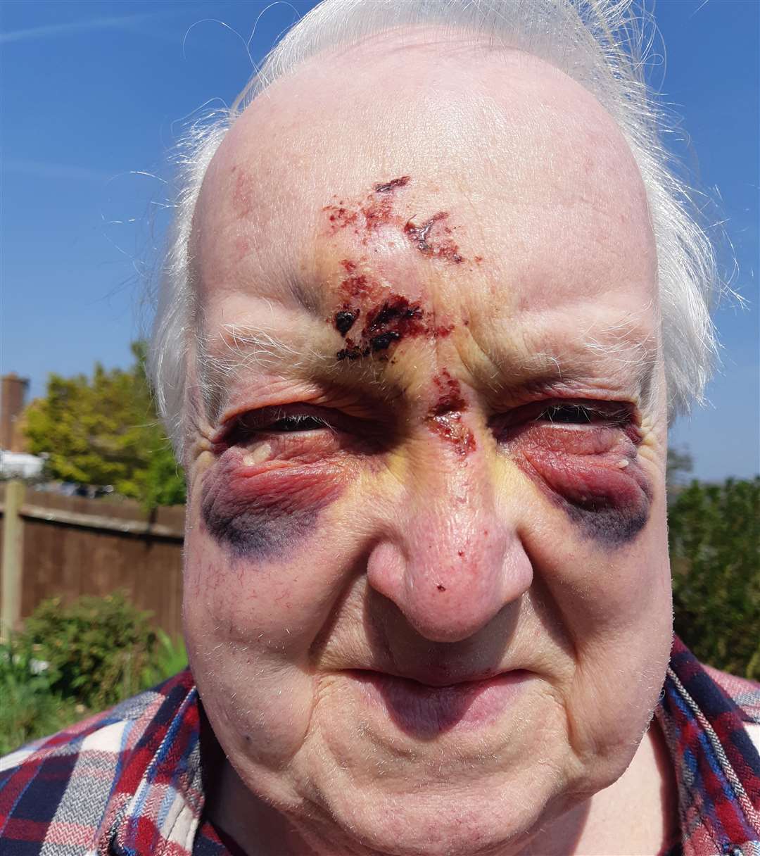 John Pink of Goodwood Close, High Halstow has been left badly bruised and bleeding after his fall (8625108)