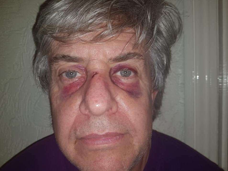 Peter Cook was left with black eyes after the attack