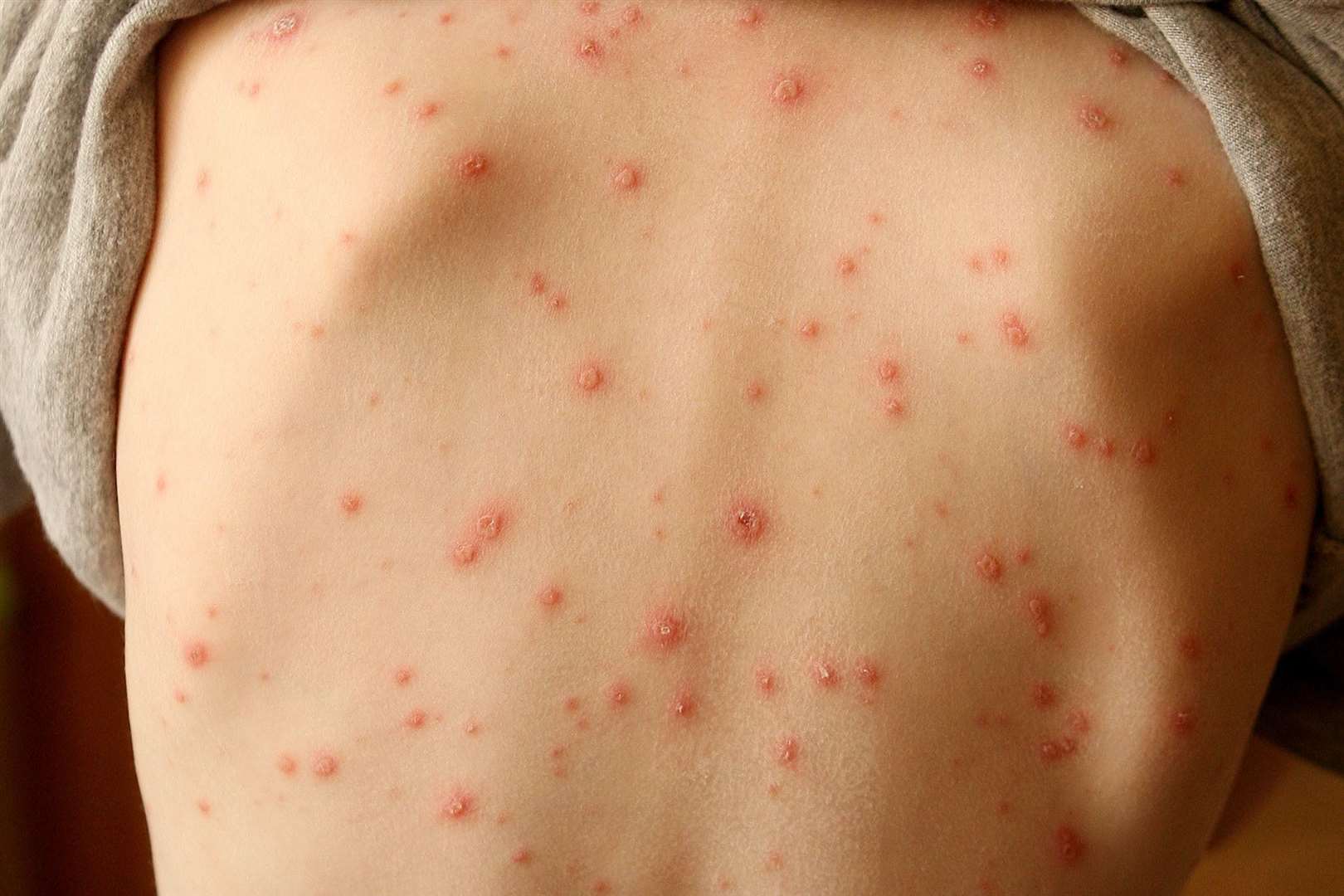 Skin Rash Should Be Considered Key Symptom Of Coronavirus Say Scientists   U3IQ2DZR0RLB1C72DGS1 