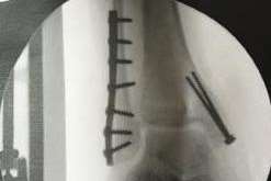 The X-Ray showing metal plates that have been placed to repair the man's ankle