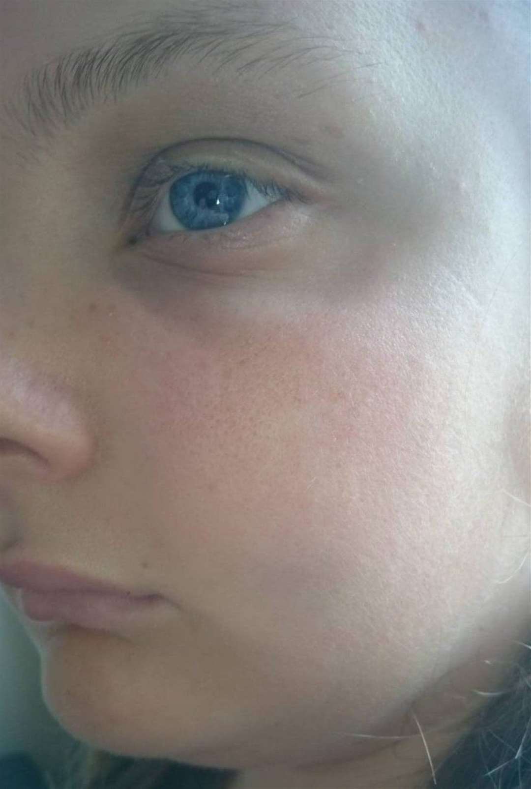 Courtney Monksfield's swollen face following the procedure. Picture: SWNS