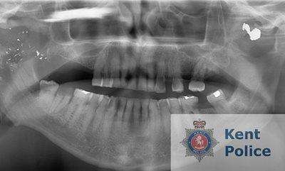 X-Ray of Ray Weatherall's face (5515825)