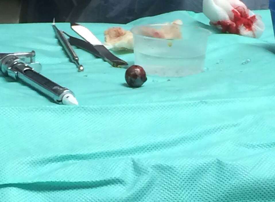 Mr De Barros had to travel to hospital in East Grinstead to have the ball bearing removed