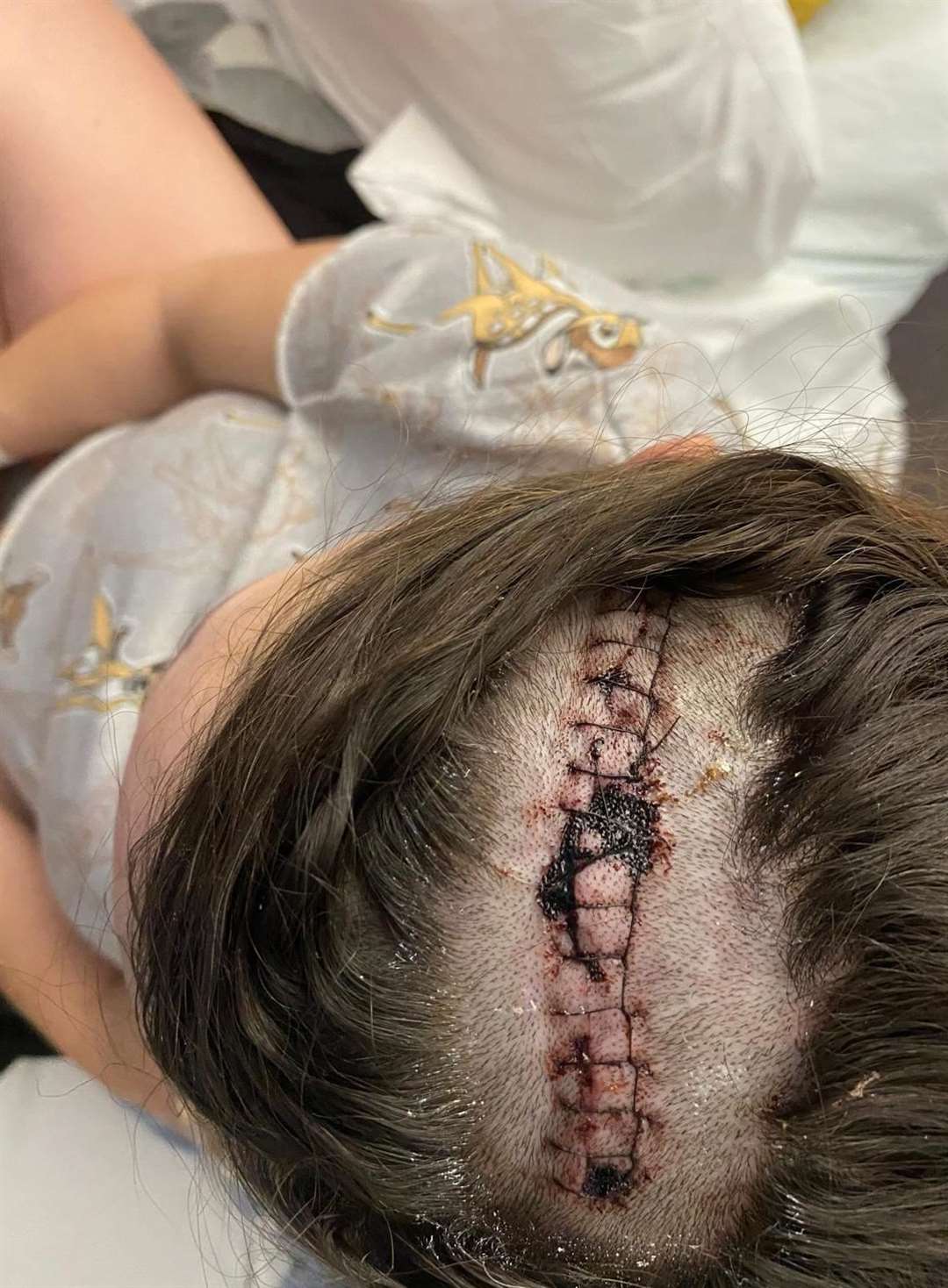 The scar from Kelly's brain surgery. Picture: Kelly Heather