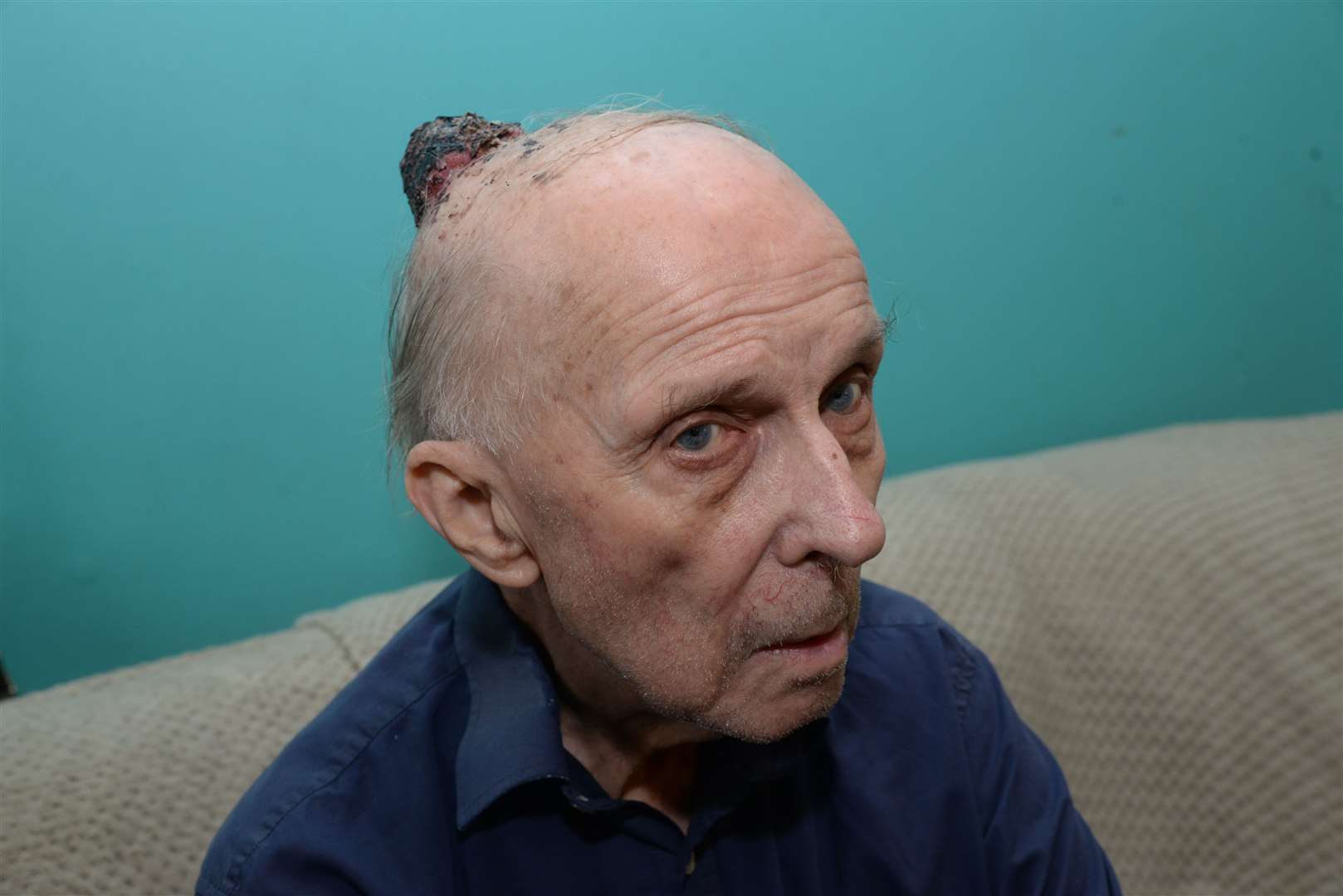 George Hobbs from Gillingham has been left with a huge growth on his head that turned out to be skin cancer. Picture: Chris Davey